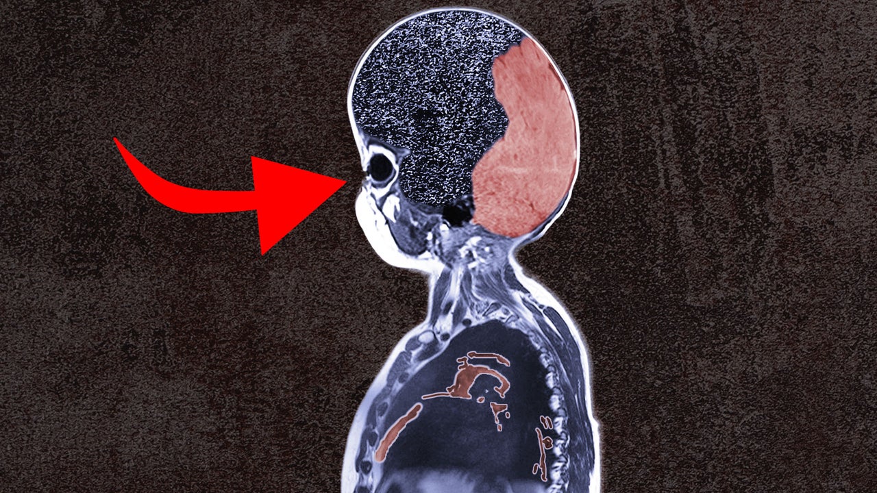 Insane Syphilis Situation In Michigan | Nebula